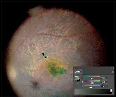 Customized Color Settings of Digitally Assisted Vitreoretinal Surgery to Enable Use of Lower Dye Concentrations During Macular Surgery